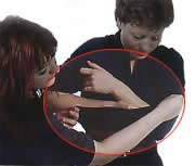 Fracture du membre suprieur