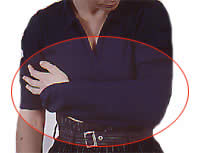 Fracture du membre suprieur