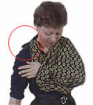 Fracture du membre suprieur